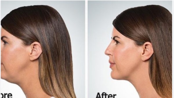 بدون جراحة وعمليات.. طرق سحرية لـ تقليل دهون الوجه بشكل طبيعي 1 59467714326820250824082103213