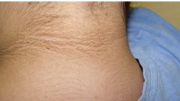 البقع الداكنة المخملية على الجلد تشير للإصابة بمرض خطير.. تفاصيل 1 594677143268202602010945474547