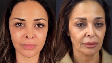 بعد تصدرها التريند.. تفاصيل عملية تجميل داليا البحيري 5 5961037377933202602010857525752