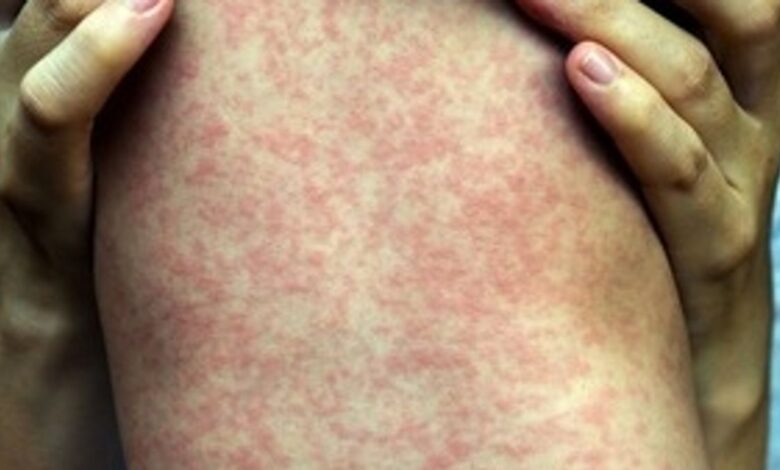 As Measles Makes a Comeback, See Your Local Vaccination Rates