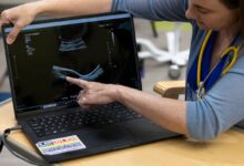 PCOS might affect men too—what a name shift could mean