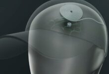 Brain-cap implant trial for depression: a 20-minute path to relief?
