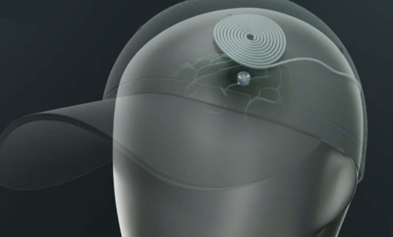 Brain-cap implant trial for depression: a 20-minute path to relief?