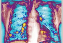 Cold-like RSV boosts lung immunity, slowing cancer spread