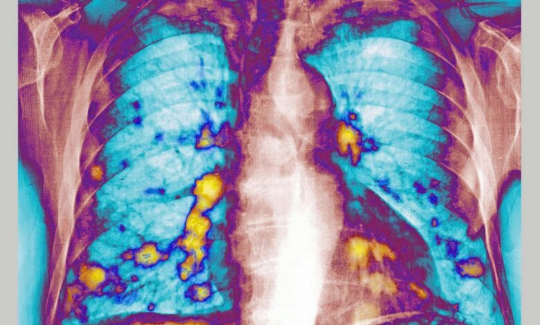 Cold-like RSV boosts lung immunity, slowing cancer spread