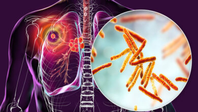 Tuberculosis in Ethiopia: A Persistent Silent Crisis