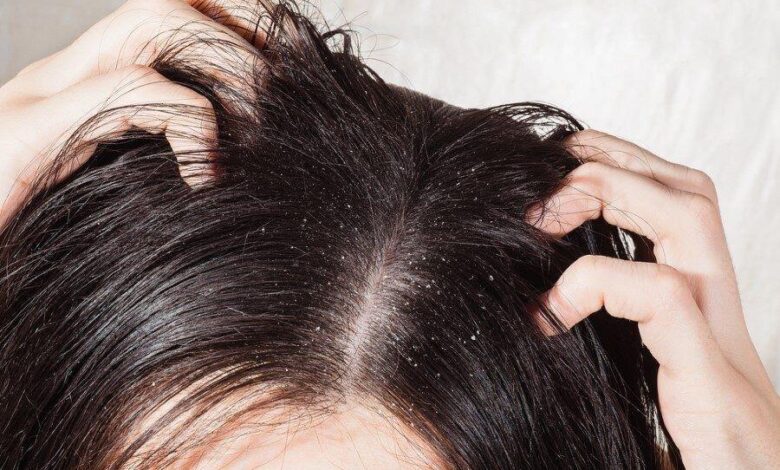 Kəpəyi yox edən təbii üsullar: evdə rahat rahat tətbiq edin