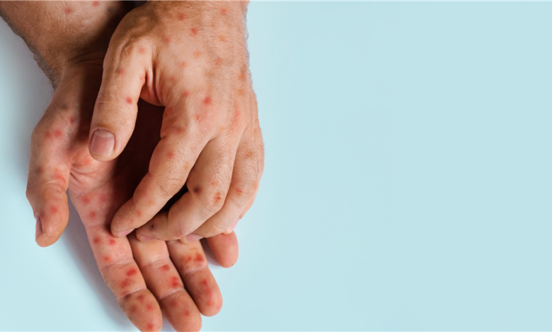 Confirman quinto caso de sarampión en Costa Rica: alerta en Guanacaste