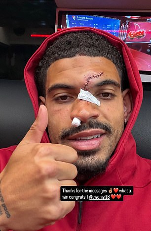 Morgan Gibbs-White shows off result of his horror head injury during Nottingham Forest's win at Chelsea - just days before Europa League semi-final second leg against Aston Villa