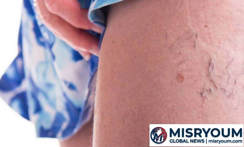 Natural Health: Managing Spider Veins and Skin Itch Natural Health: Managing Spider Veins and Skin Itch