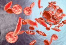 The scientists whose work led to a game-changing therapy for sickle cell disease worry those most vulnerable can’t access it