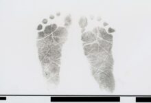 Autopsies Detail Preventable Deaths After Vitamin K Refusal