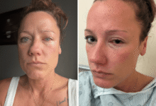 Woman’s nail glue mistake leaves painful eye burns