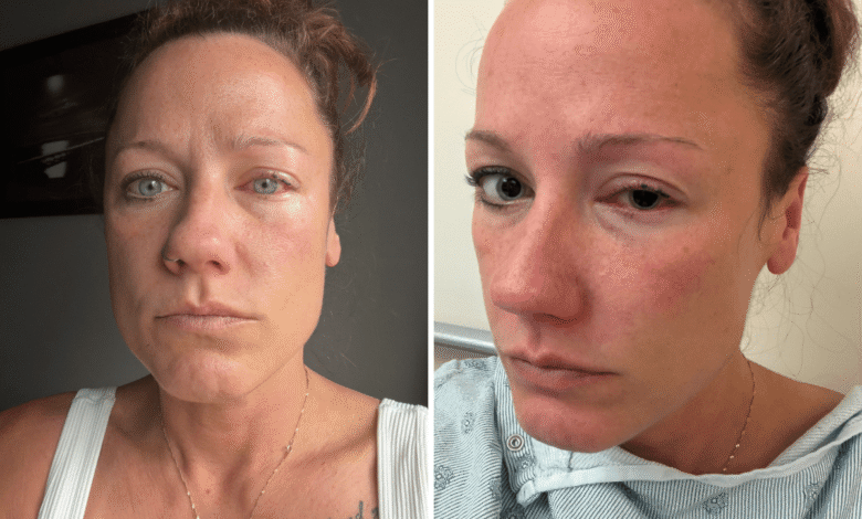 Woman’s nail glue mistake leaves painful eye burns