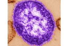 Confirmed measles case reported in Kane County