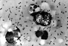 Pneumonic plague symptoms explained after Russian scientist’s death